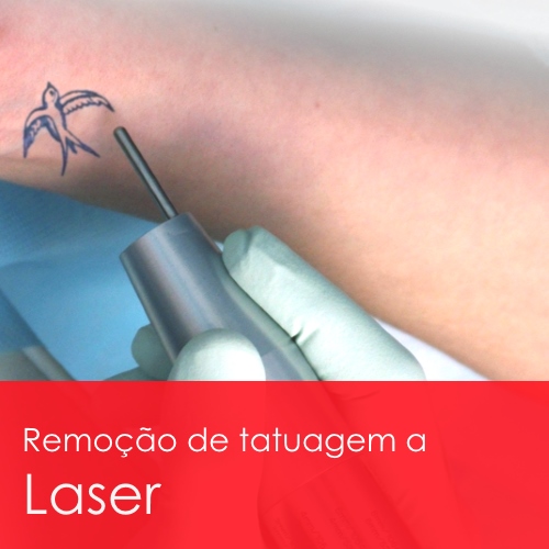 Remoção de tatuagem a laser Destatuagem